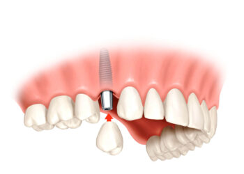 Все про зубну імплантацію