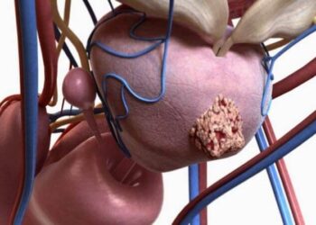 Рак простаты: стоимость лечения за рубежом