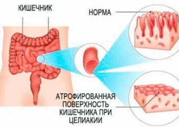 Чем опасна нелеченая энтеропатия