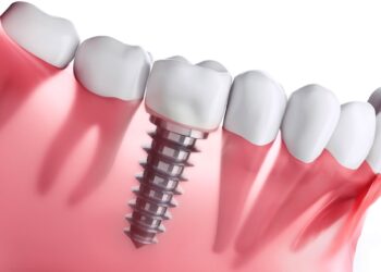 Имплантация зубов: современное решение при потере зуба