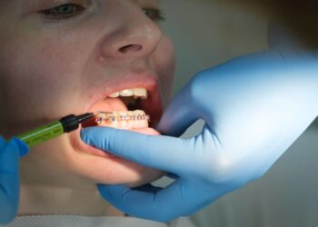 Как проходит выравнивание зубов брекетами: что стоит знать перед началом лечения